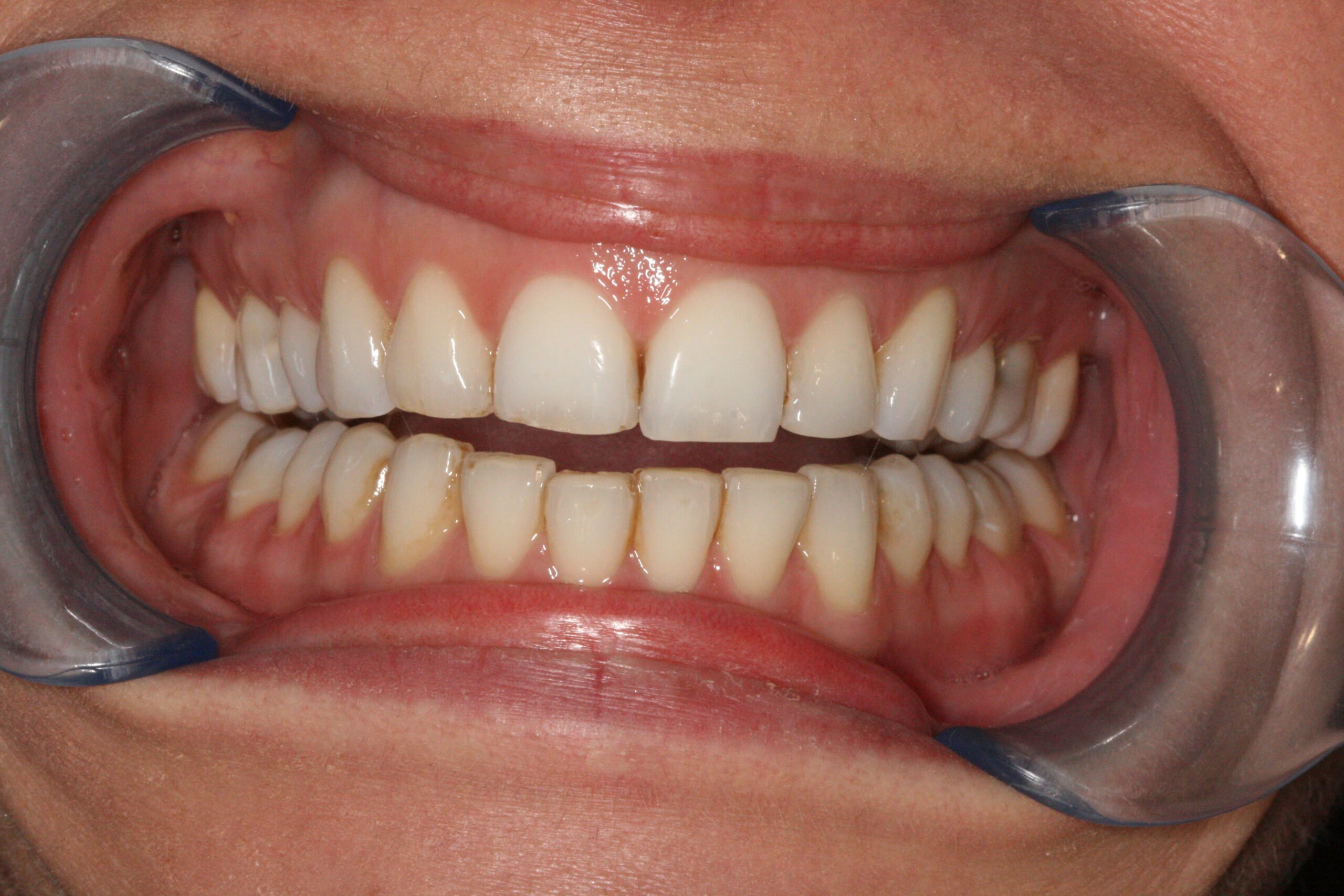 After Treatment Smile