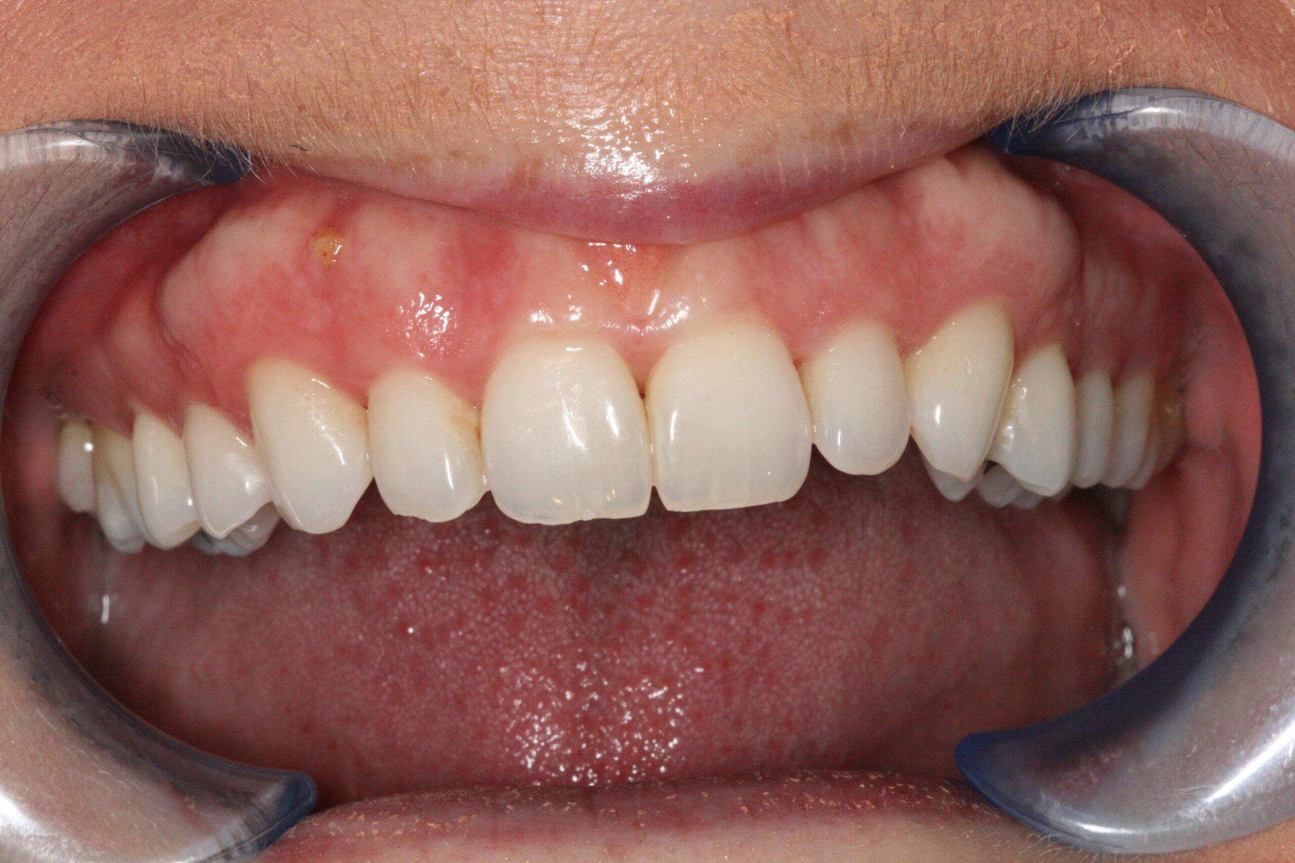 Before Treatment Smile
