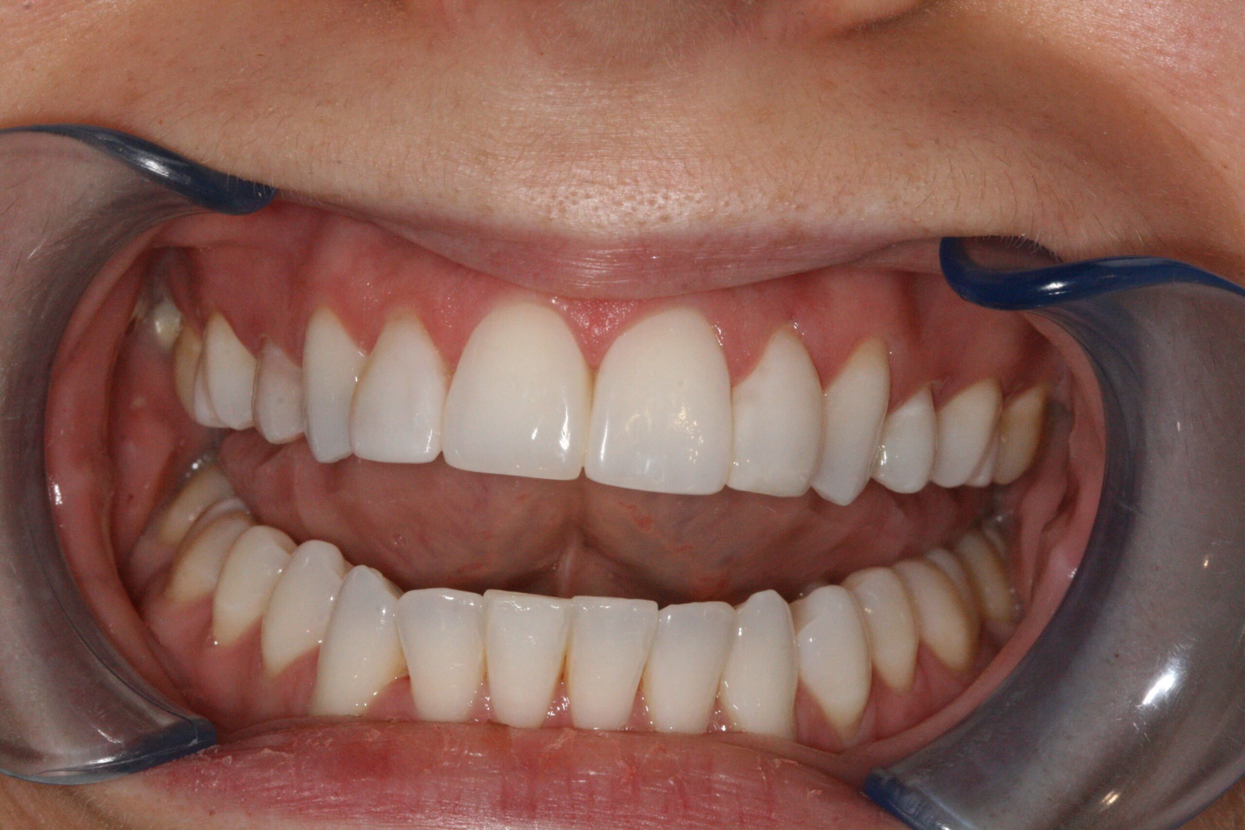 What Exactly Is Root Canal Treatment & Why You Shouldn’t Fear It