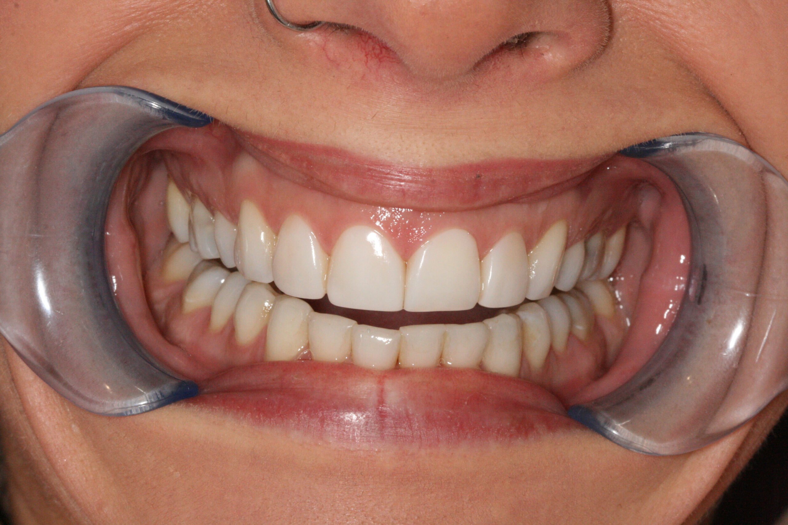 After Treatment Smile