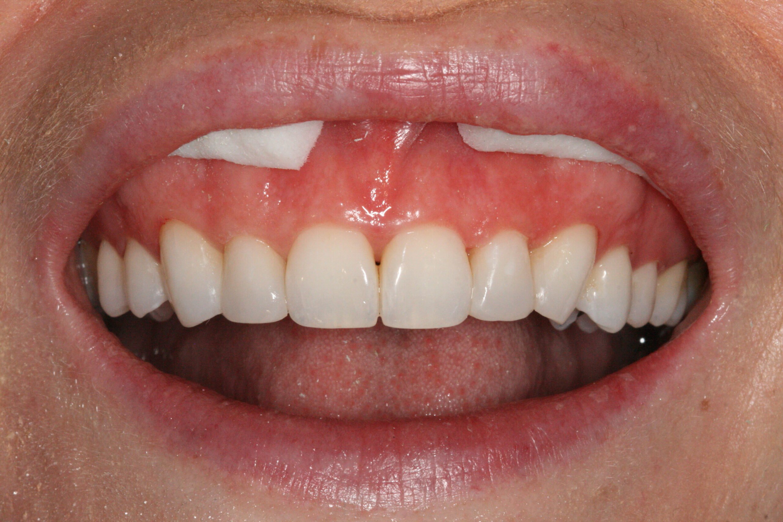 Before Treatment Smile