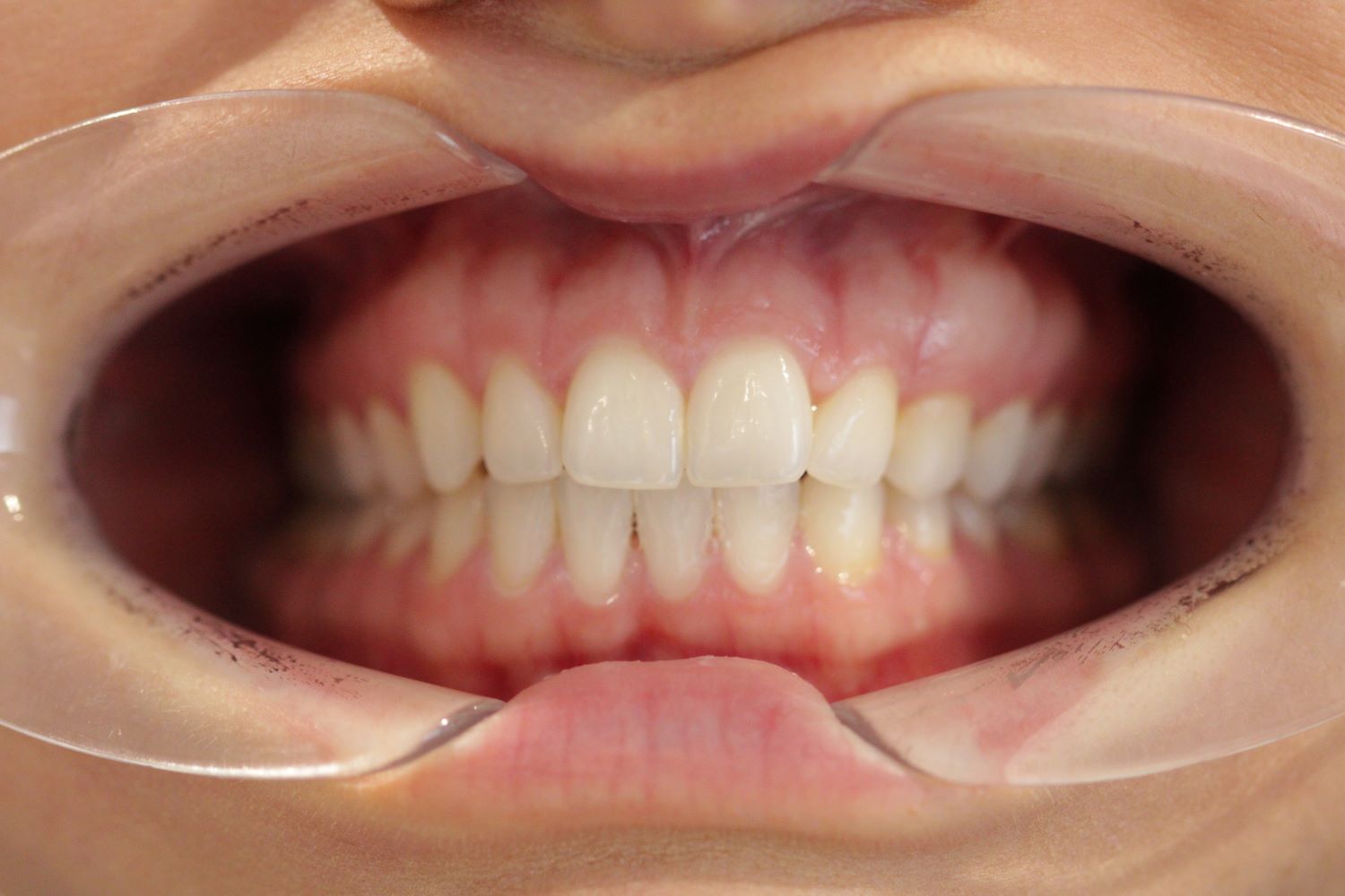 After Treatment Smile