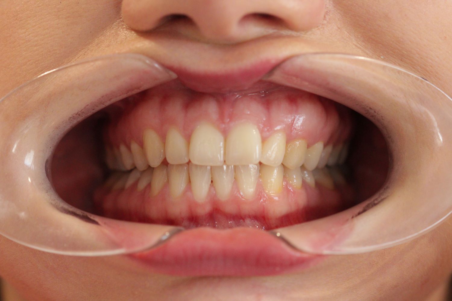 Before Treatment Smile